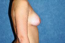 Breast Augmentation After Photo by Francis(Frank) Rieger, MD; Tampa, FL - Case 8439