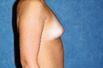 Breast Augmentation Before Photo by Francis(Frank) Rieger, MD; Tampa, FL - Case 8439