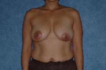 Breast Reduction Before Photo by Francis(Frank) Rieger, MD; Tampa, FL - Case 8447