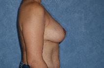 Breast Reduction After Photo by Francis(Frank) Rieger, MD; Tampa, FL - Case 8447