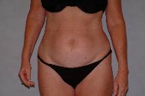 Liposuction Before Photo by Francis(Frank) Rieger, MD; Tampa, FL - Case 8484