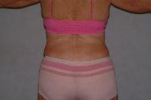Liposuction After Photo by Francis(Frank) Rieger, MD; Tampa, FL - Case 8500
