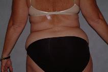 Liposuction Before Photo by Francis(Frank) Rieger, MD; Tampa, FL - Case 8500