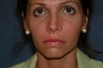 Dermal Fillers After Photo by Francis(Frank) Rieger, MD; Tampa, FL - Case 8572