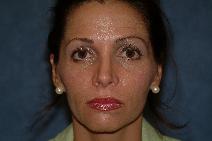 Dermal Fillers Before Photo by Francis(Frank) Rieger, MD; Tampa, FL - Case 8572