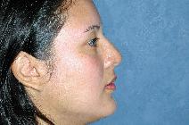 Rhinoplasty After Photo by Francis(Frank) Rieger, MD; Tampa, FL - Case 8581