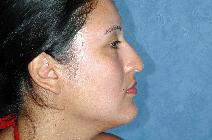 Rhinoplasty Before Photo by Francis(Frank) Rieger, MD; Tampa, FL - Case 8581
