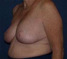 Breast Reduction After Photo by Bruce Brewer, MD, FACS; Garden City, NY - Case 28013