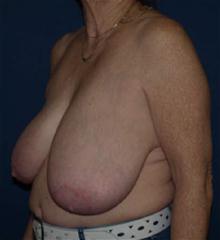 Breast Reduction Before Photo by Bruce Brewer, MD, FACS; Garden City, NY - Case 28013