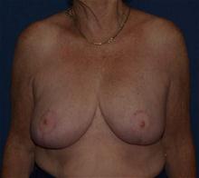 Breast Reduction After Photo by Bruce Brewer, MD, FACS; Garden City, NY - Case 28013