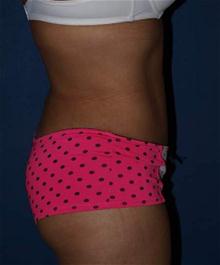 Tummy Tuck After Photo by Bruce Brewer, MD, FACS; Garden City, NY - Case 28023