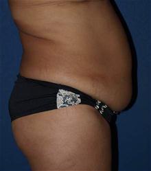 Tummy Tuck Before Photo by Bruce Brewer, MD, FACS; Garden City, NY - Case 28023