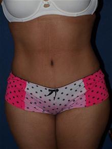 Tummy Tuck After Photo by Bruce Brewer, MD, FACS; Garden City, NY - Case 28023