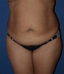 Tummy Tuck Before Photo by Bruce Brewer, MD, FACS; Garden City, NY - Case 28023