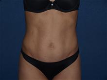 Tummy Tuck After Photo by Bruce Brewer, MD, FACS; Garden City, NY - Case 28537