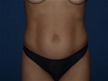Tummy Tuck Before Photo by Bruce Brewer, MD, FACS; Garden City, NY - Case 28537