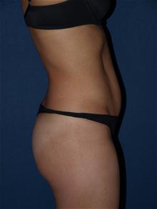 Tummy Tuck After Photo by Bruce Brewer, MD, FACS; Garden City, NY - Case 28537