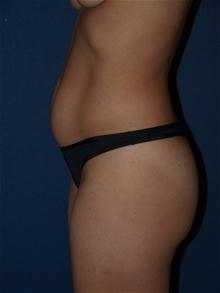 Tummy Tuck Before Photo by Bruce Brewer, MD, FACS; Garden City, NY - Case 28537