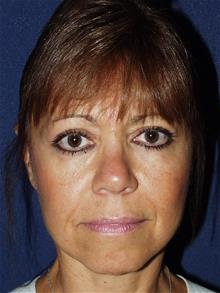 Facelift After Photo by Bruce Brewer, MD, FACS; Garden City, NY - Case 29097