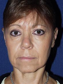 Facelift Before Photo by Bruce Brewer, MD, FACS; Garden City, NY - Case 29097