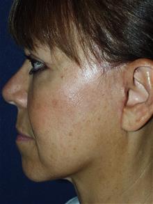 Facelift After Photo by Bruce Brewer, MD, FACS; Garden City, NY - Case 29097