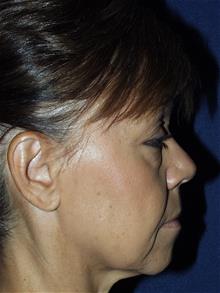 Facelift Before Photo by Bruce Brewer, MD, FACS; Garden City, NY - Case 29097