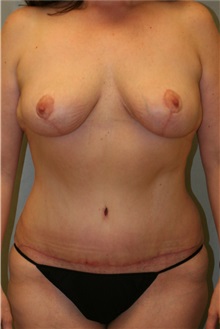 Breast Lift After Photo by Meegan Gruber, MD; Tampa, FL - Case 22454