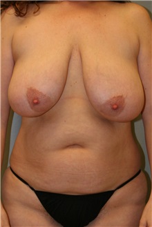Breast Lift Before Photo by Meegan Gruber, MD; Tampa, FL - Case 22454