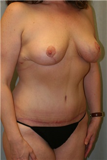 Breast Lift After Photo by Meegan Gruber, MD; Tampa, FL - Case 22454
