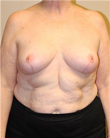 Breast Reduction After Photo by Meegan Gruber, MD; Tampa, FL - Case 22458
