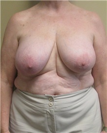 Breast Reduction Before Photo by Meegan Gruber, MD; Tampa, FL - Case 22458