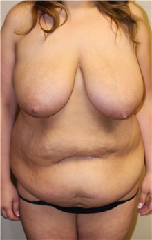 Tummy Tuck Before Photo by Meegan Gruber, MD; Tampa, FL - Case 22460