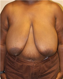Breast Reduction Before Photo by Meegan Gruber, MD; Tampa, FL - Case 22468