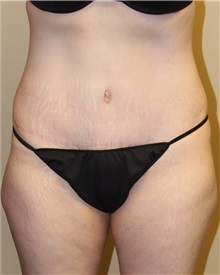 Tummy Tuck After Photo by Meegan Gruber, MD; Tampa, FL - Case 22471