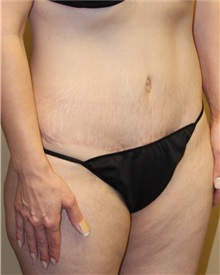 Tummy Tuck After Photo by Meegan Gruber, MD; Tampa, FL - Case 22471