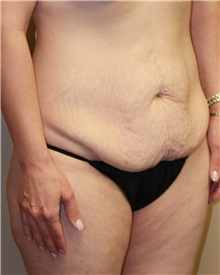 Tummy Tuck Before Photo by Meegan Gruber, MD; Tampa, FL - Case 22471