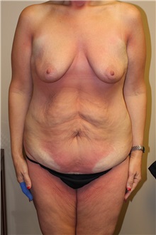 Body Contouring Before Photo by Meegan Gruber, MD; Lakewood Ranch, FL - Case 22472