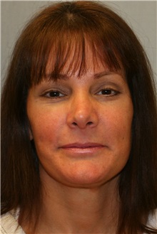 Facelift After Photo by Meegan Gruber, MD; Lakewood Ranch, FL - Case 23892