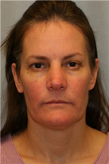Facelift Before Photo by Meegan Gruber, MD; Lakewood Ranch, FL - Case 23892