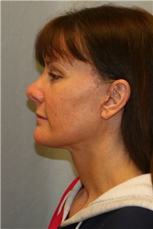 Facelift After Photo by Meegan Gruber, MD; Tampa, FL - Case 23892