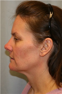 Facelift Before Photo by Meegan Gruber, MD; Tampa, FL - Case 23892
