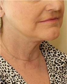 Facelift After Photo by Meegan Gruber, MD; Tampa, FL - Case 23893
