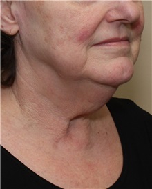 Facelift Before Photo by Meegan Gruber, MD; Tampa, FL - Case 23893