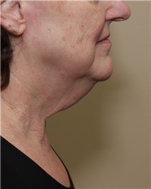 Facelift Before Photo by Meegan Gruber, MD; Tampa, FL - Case 23893