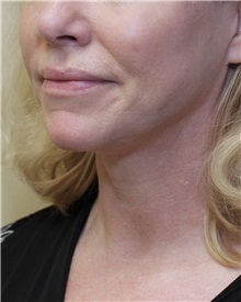 Facelift After Photo by Meegan Gruber, MD; Tampa, FL - Case 23894
