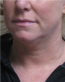 Facelift Before Photo by Meegan Gruber, MD; Tampa, FL - Case 23894