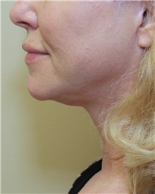 Facelift After Photo by Meegan Gruber, MD; Tampa, FL - Case 23894
