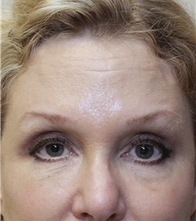 Eyelid Surgery After Photo by Meegan Gruber, MD; Tampa, FL - Case 23899
