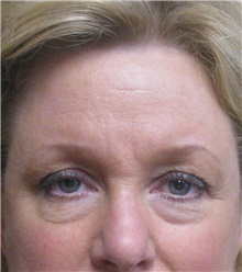 Eyelid Surgery Before Photo by Meegan Gruber, MD; Lakewood Ranch, FL - Case 23899
