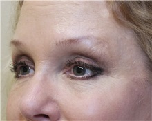Eyelid Surgery After Photo by Meegan Gruber, MD; Tampa, FL - Case 23899